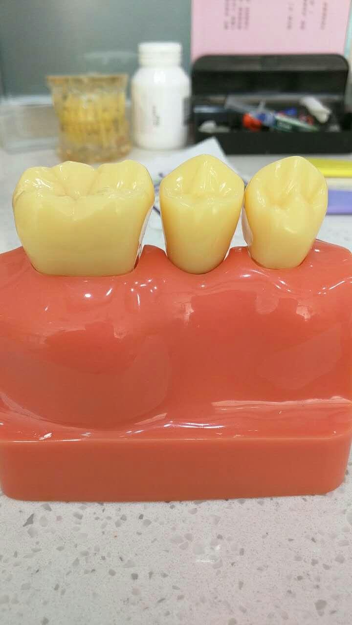 烤瓷桥掉了以后是继续做烤瓷牙桥还是种植牙加烤瓷牙冠