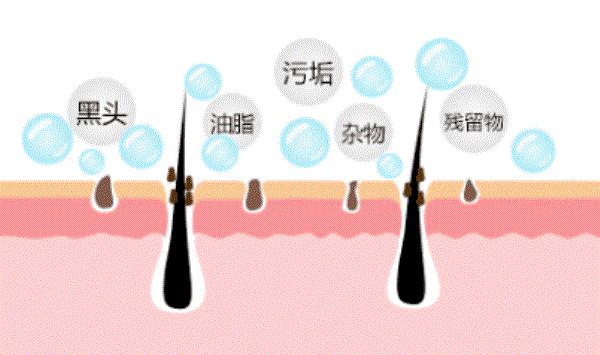 为什么一用卸妆油就起闭口?