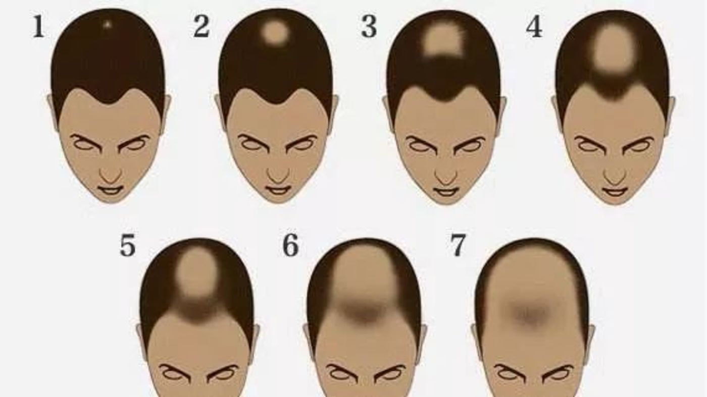 从临床上来看,多数头发稀疏,都是因为雄激素脱发所致
