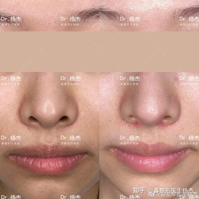 鼻槛整形之鼻槛下垂的治疗