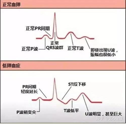 坏死性q波是什么图片