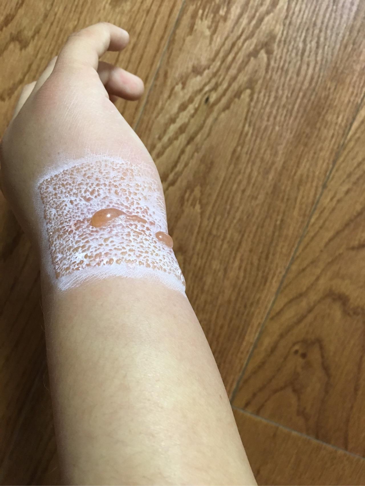 为什么有的人会对创可贴/胶布过敏?过敏原是什么?是过敏吗? - 知乎