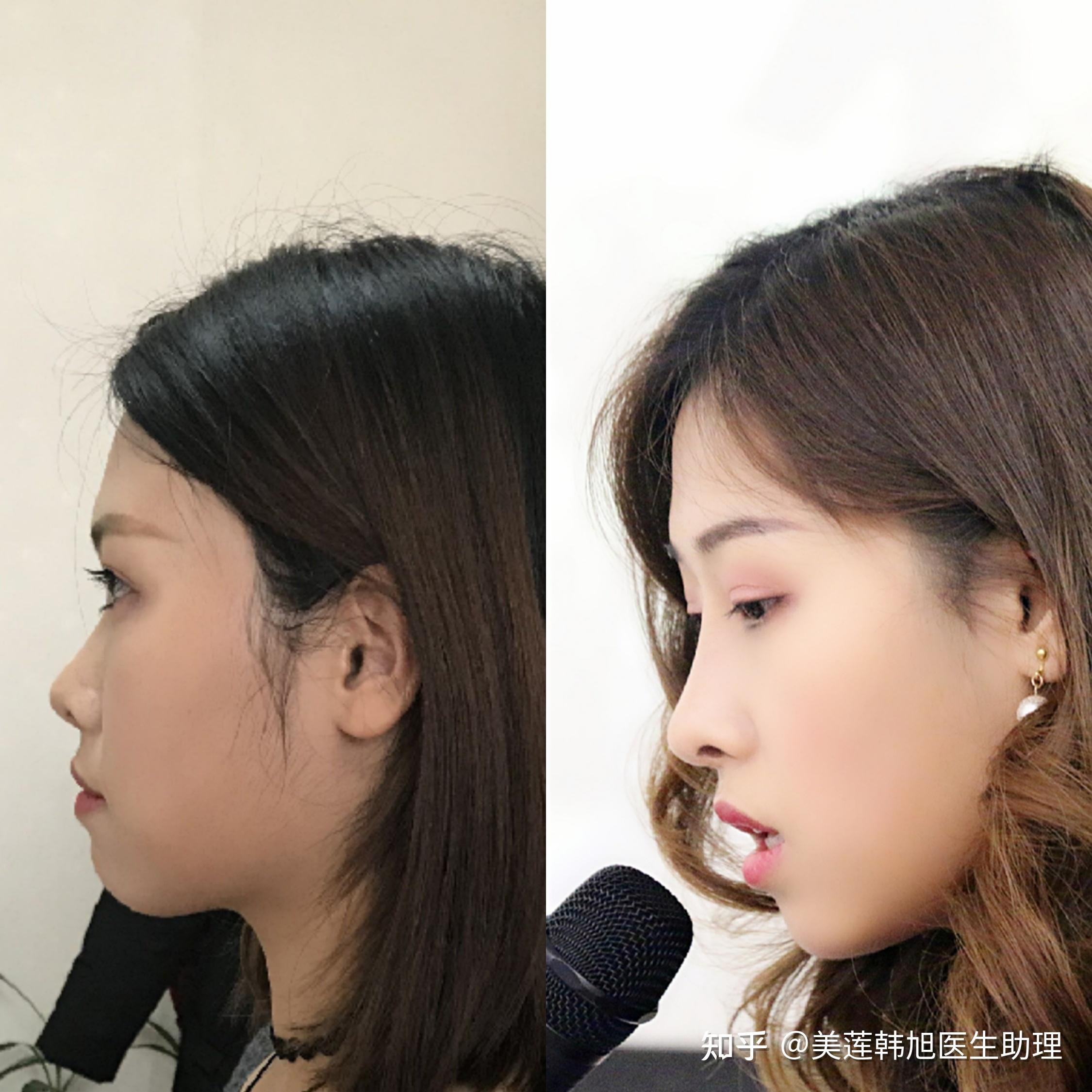 肿眼泡,塌鼻子,预算有限的情况下是先割双眼皮还是隆鼻? - 知乎