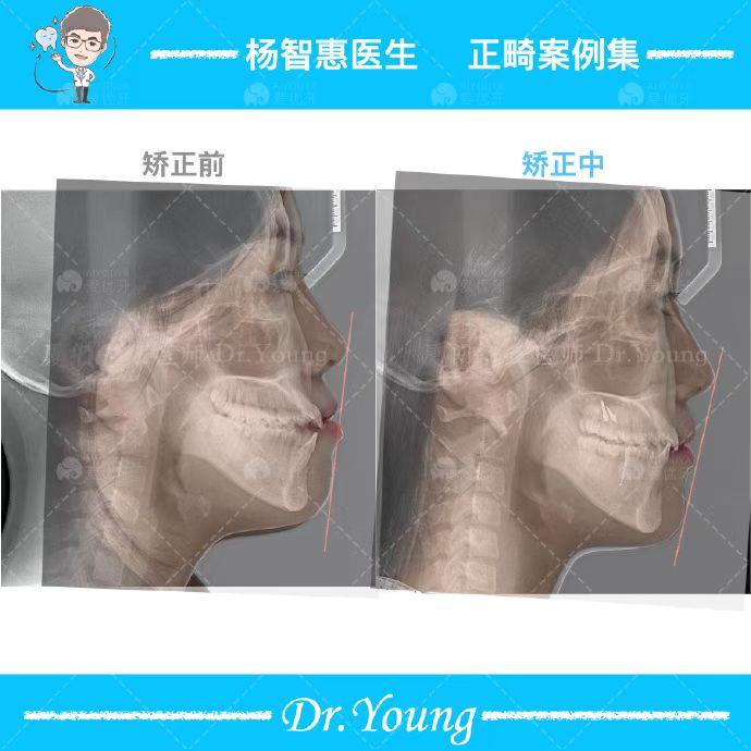 厦门牙齿矫正|地包天+嘴突隐适美矫正|矫正中案例 - 知乎