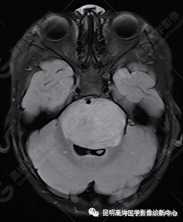脑干弥漫性中线胶质瘤一例武汉高尚医学影像