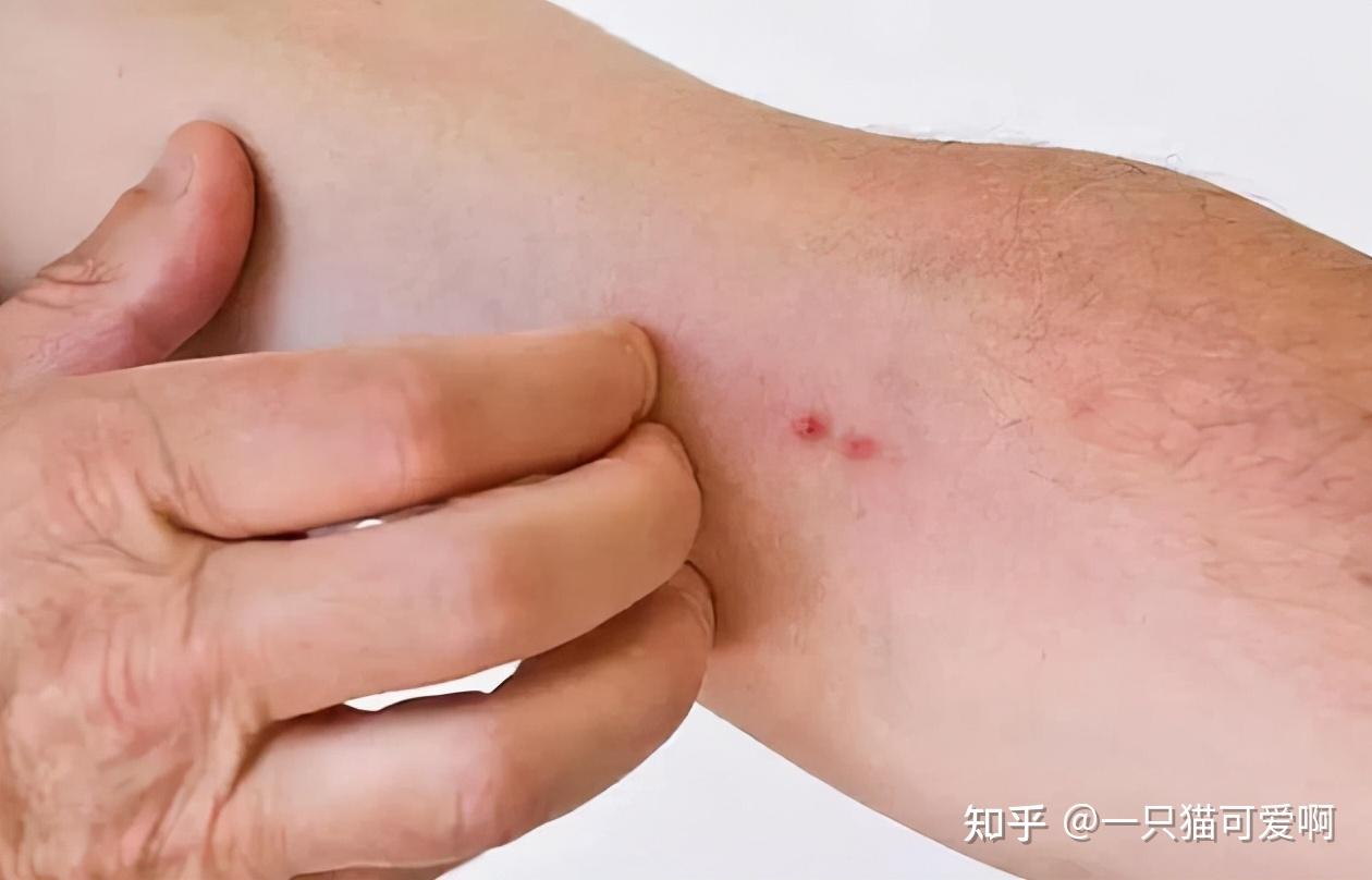 夫妻俩天天出入洗浴中心不幸双双感染hpv医生太不自爱