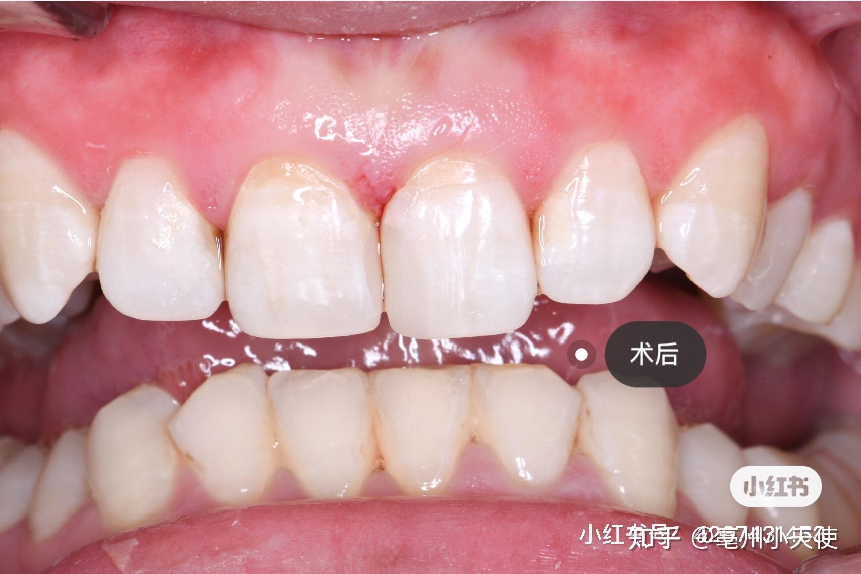 门牙修复日记 - 知乎