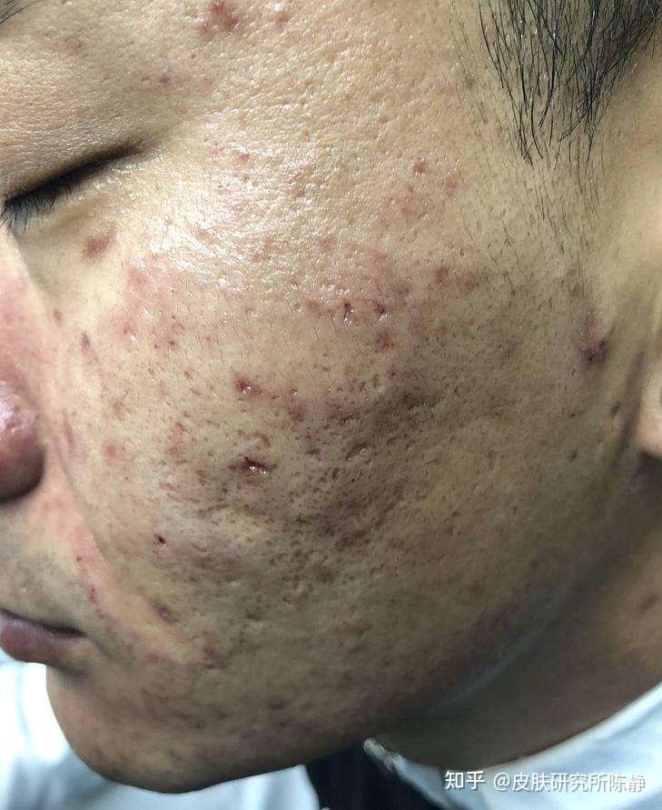 讨厌的痘痘痘印先祛痘还是先消印