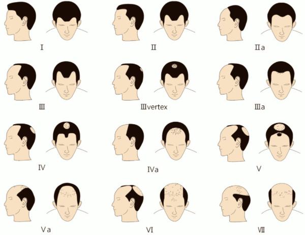 第一款脱发基因抑制剂已完成初次临床实验