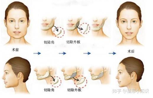 下頜角磨骨截骨臉大究竟應該做顴骨還是切下頜角