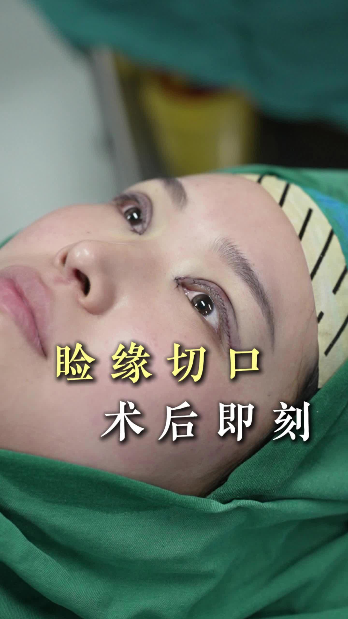 睑缘切口双眼皮术后即刻效果