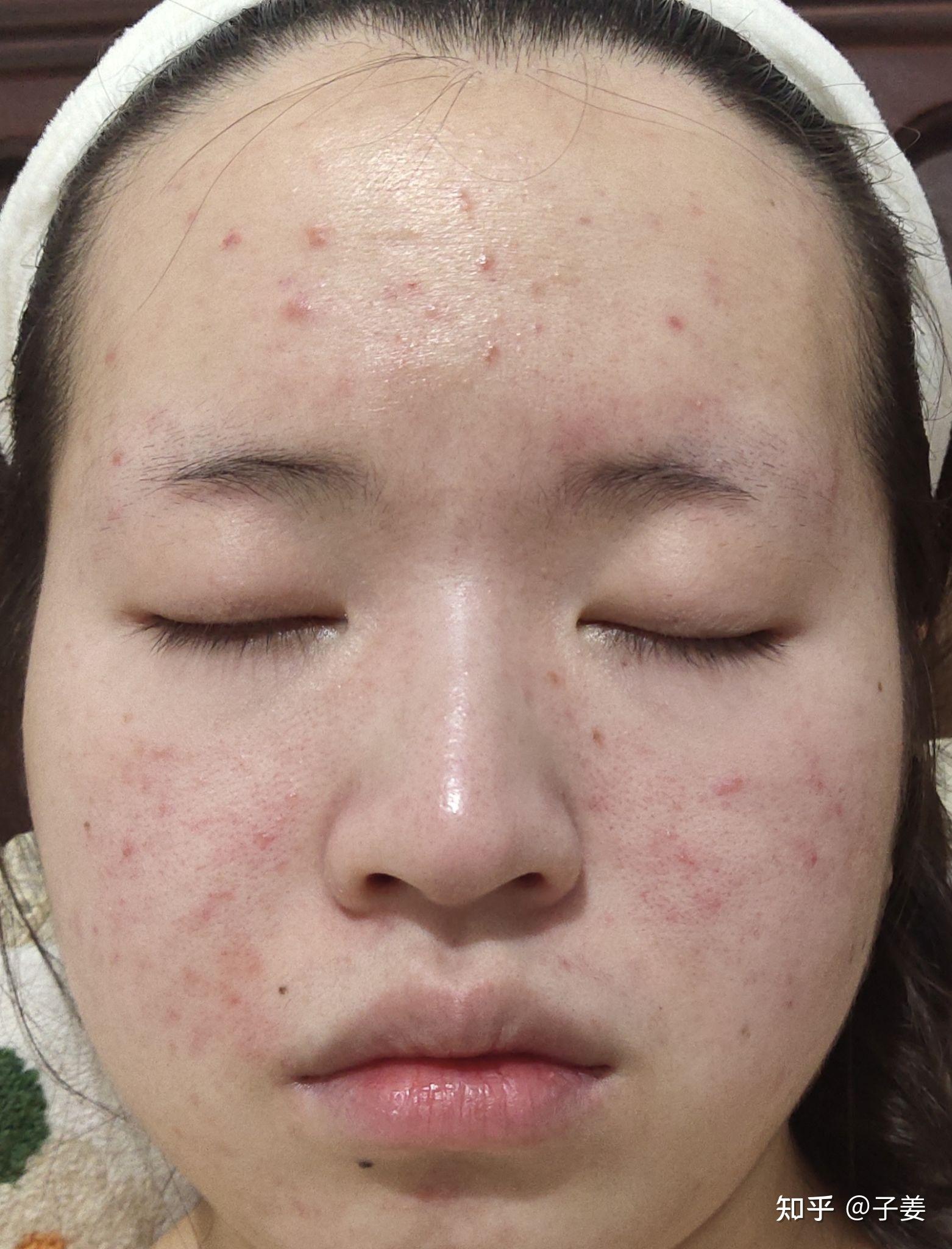 痘痘几年了 该怎么办 - 知乎
