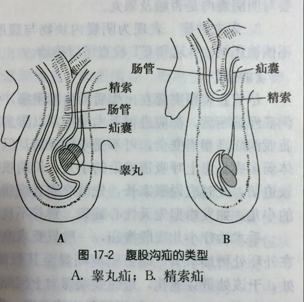 疝气手术后要穿阴囊托袋内裤有助于恢复么?