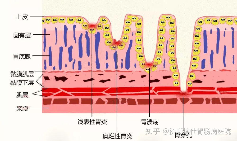 一般是由粘膜层,粘膜下层,肌层以及浆膜层这四层组成的,在发生胃糜烂