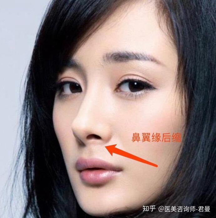 为什么鼻翼不对称? - 知乎