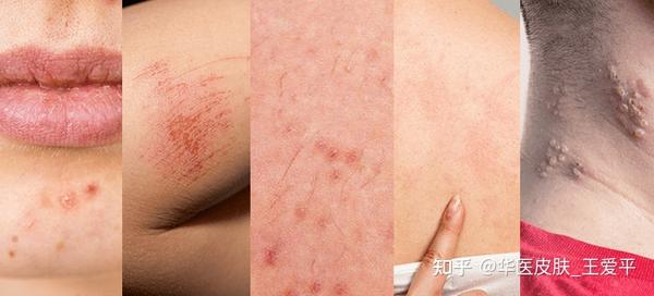 湿疹VS皮炎？盘点一下两者的区别！ - 知乎