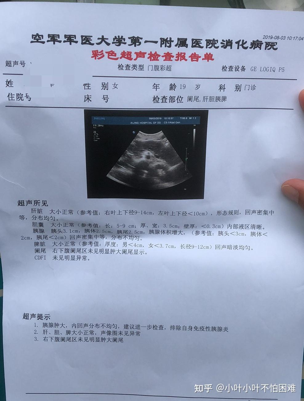 有没有人因为暴饮暴食诱发胰腺炎的? - 知乎