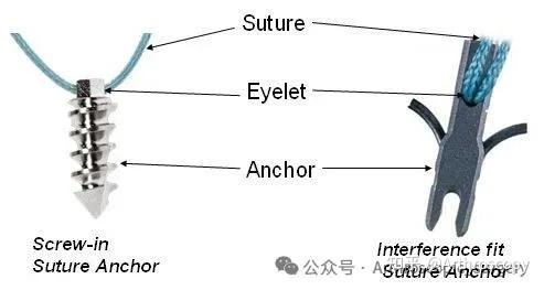 医学科普|铆钉还是锚钉? - 知乎