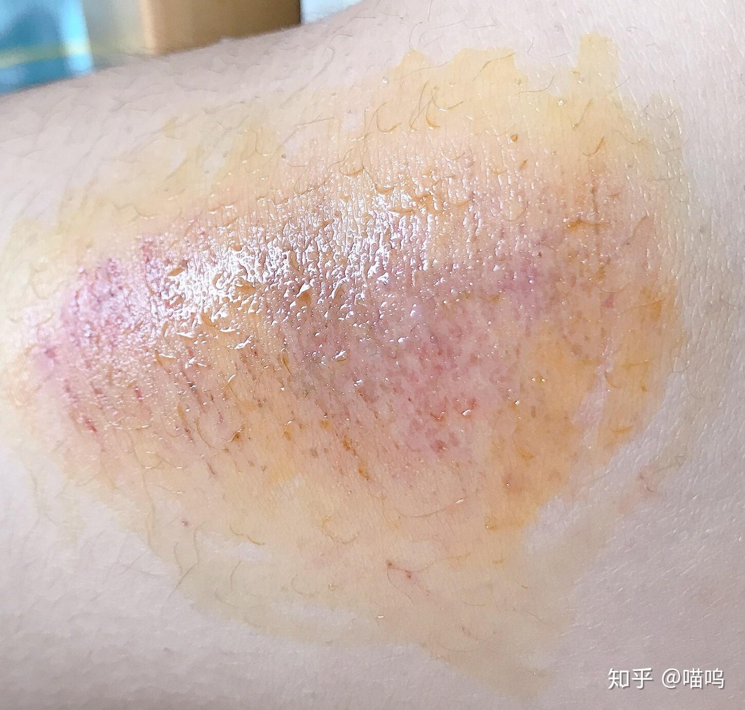 膝盖摔伤抹了碘伏结痂后如何防止留疤