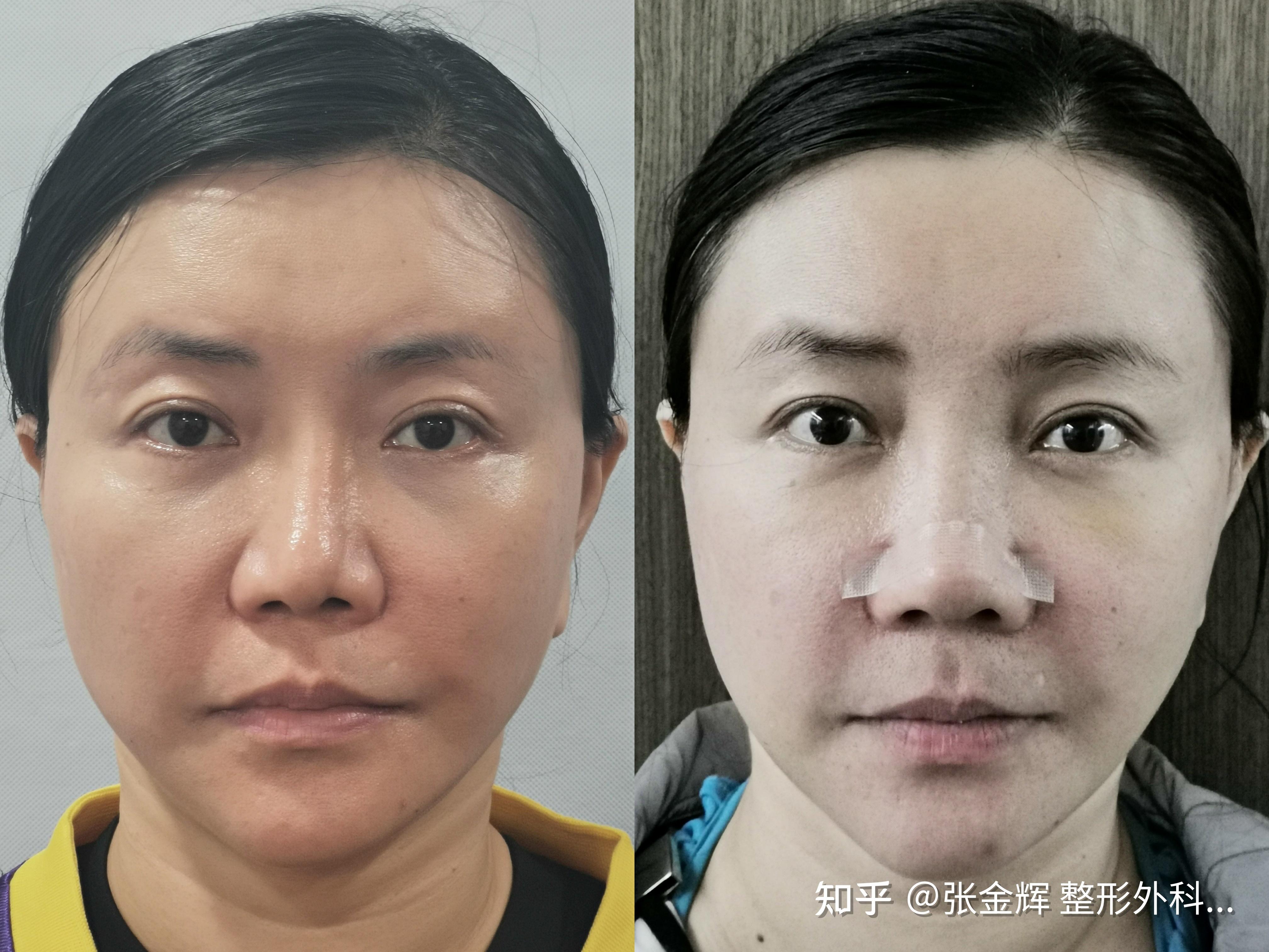 鼻基底凹陷填充后的并发症修复