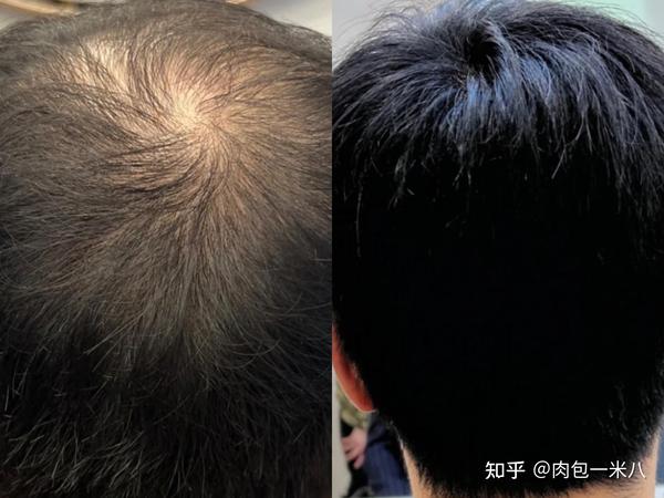为什么医学生强烈建议脱发严重秃头用育发液,3个月蜕变“发量王者”真的那么猛? - 知乎