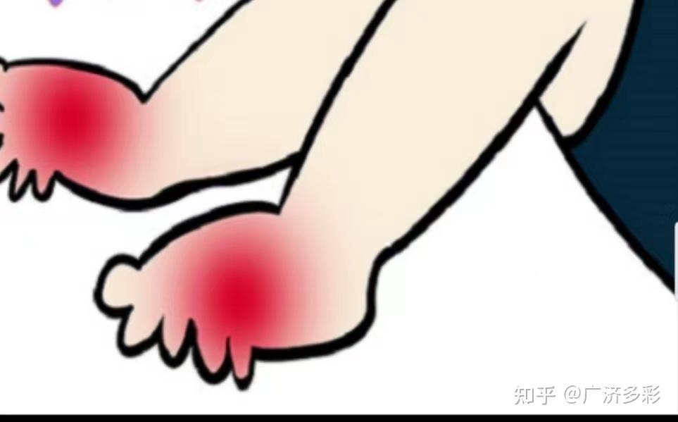 丹毒虽以“毒”命名,但却是一种细菌感染的皮肤病 - 知乎