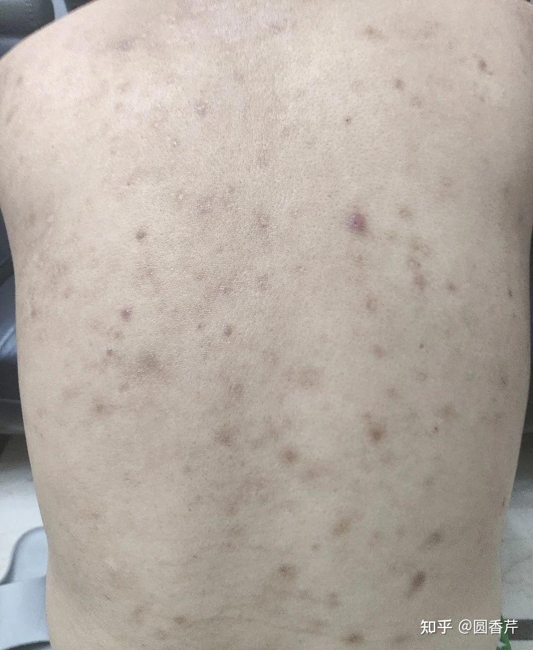 我男朋友满背都是痘痘,我要不要和他同居? - 知乎