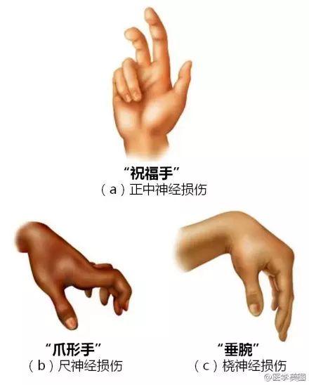 爪形手垂腕猿手图片