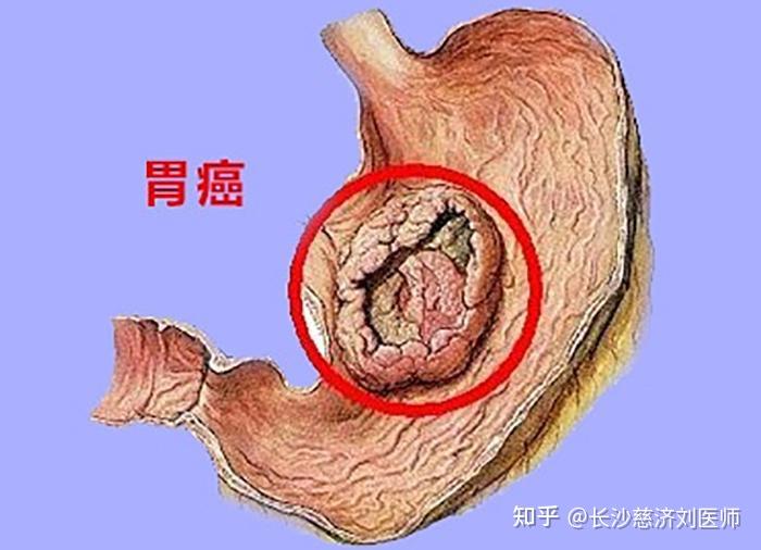 26岁胃癌晚期仅剩6个月妻子日夜守候盼奇迹