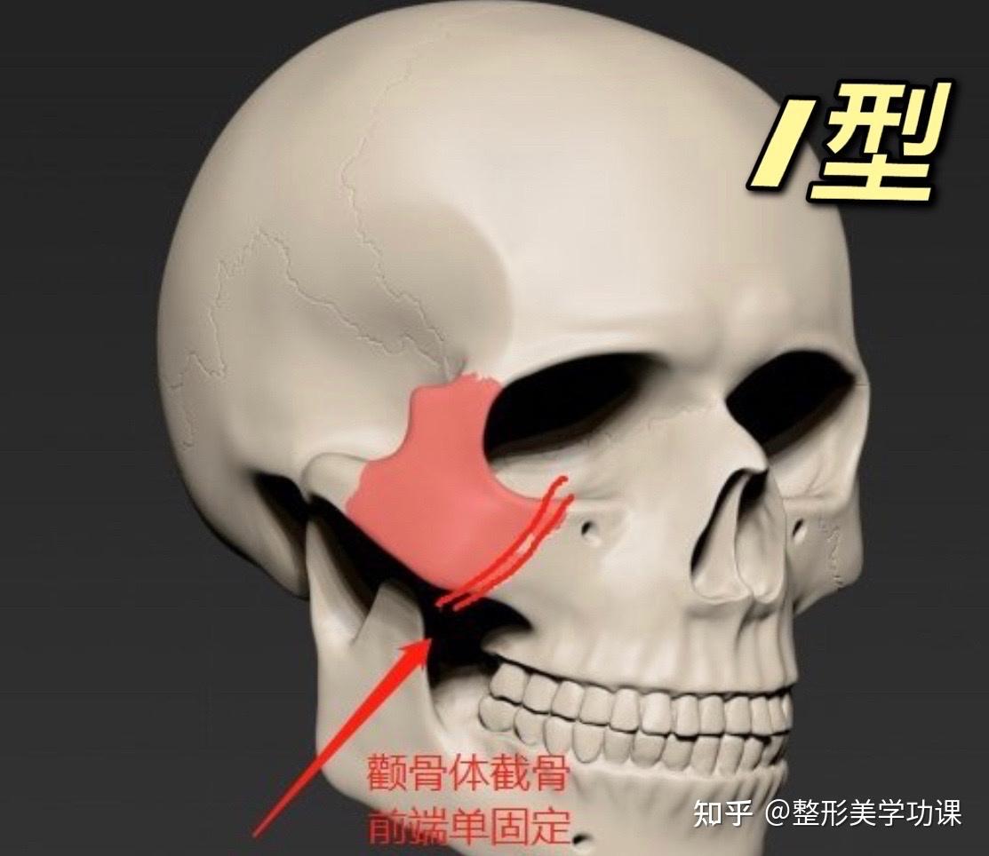 个性化3D定制重建颧骨颧弓手术临床案例分析 - 哔哩哔哩