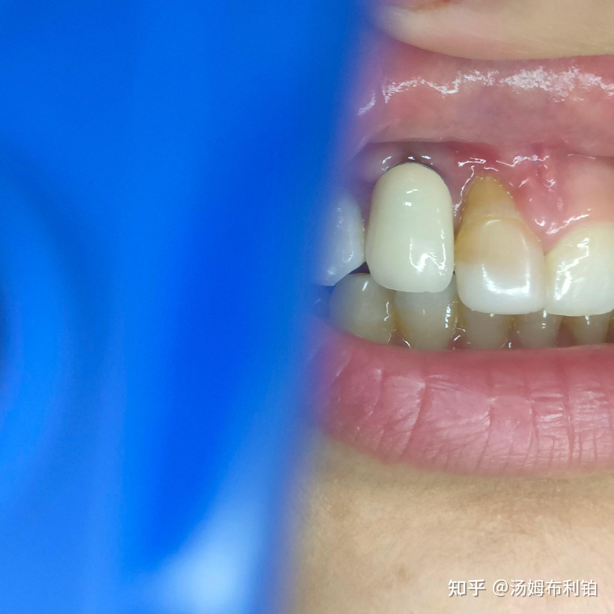 牙龈高度不一致，牙齿缺失，畸形过小牙，联合修复病例分享-谭敬宇住院医师-爱问医生