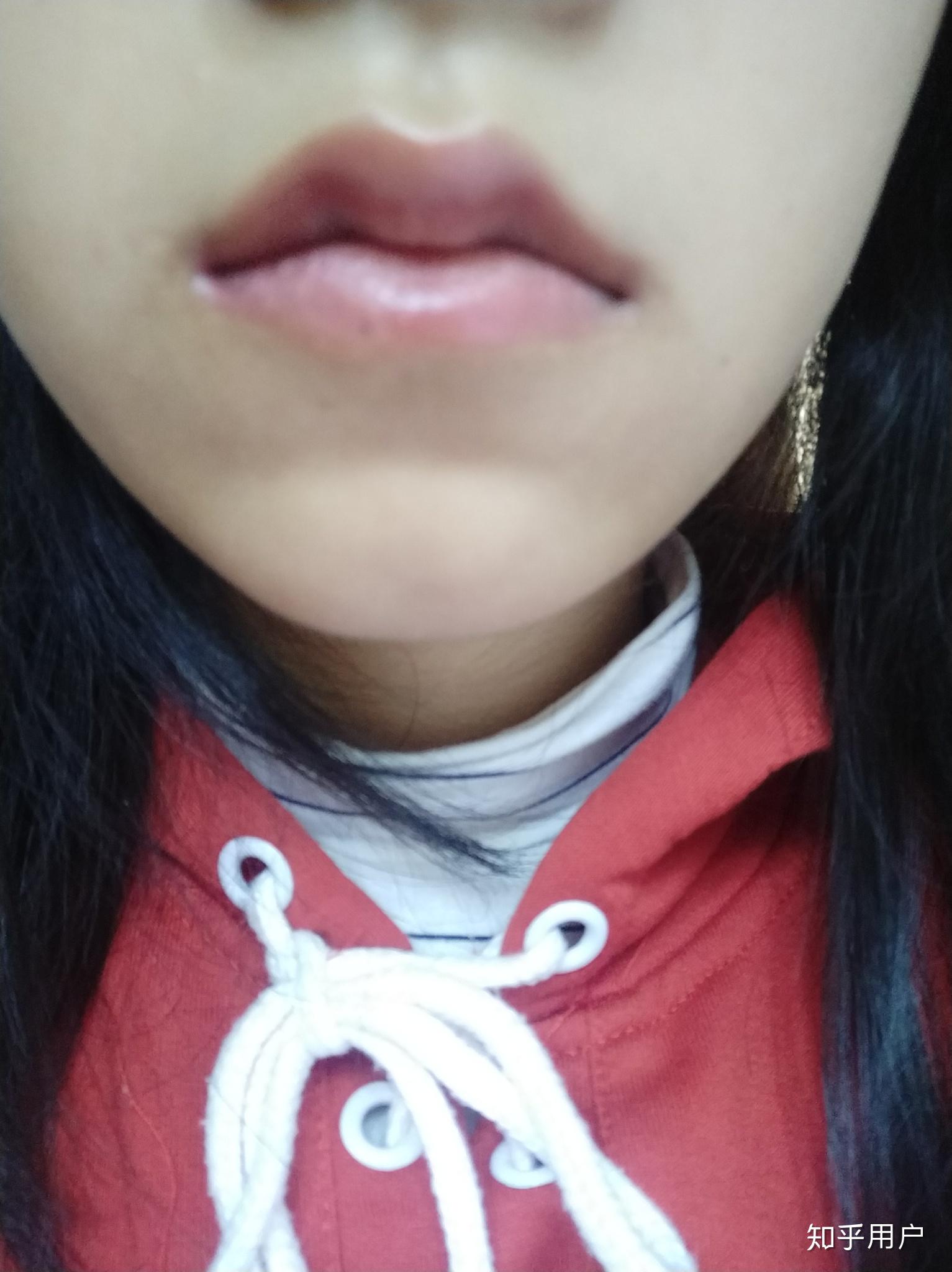 我嘴唇里有一颗很小的痣有影响吗