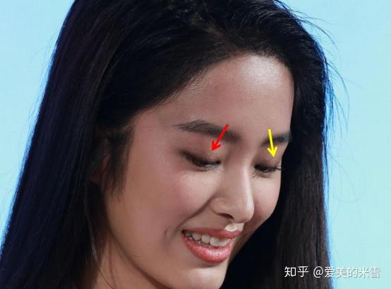 都符合,所以她的效果格外好再说鼻子,原生鼻鼻头肥大,鼻尖鼻小柱下垂