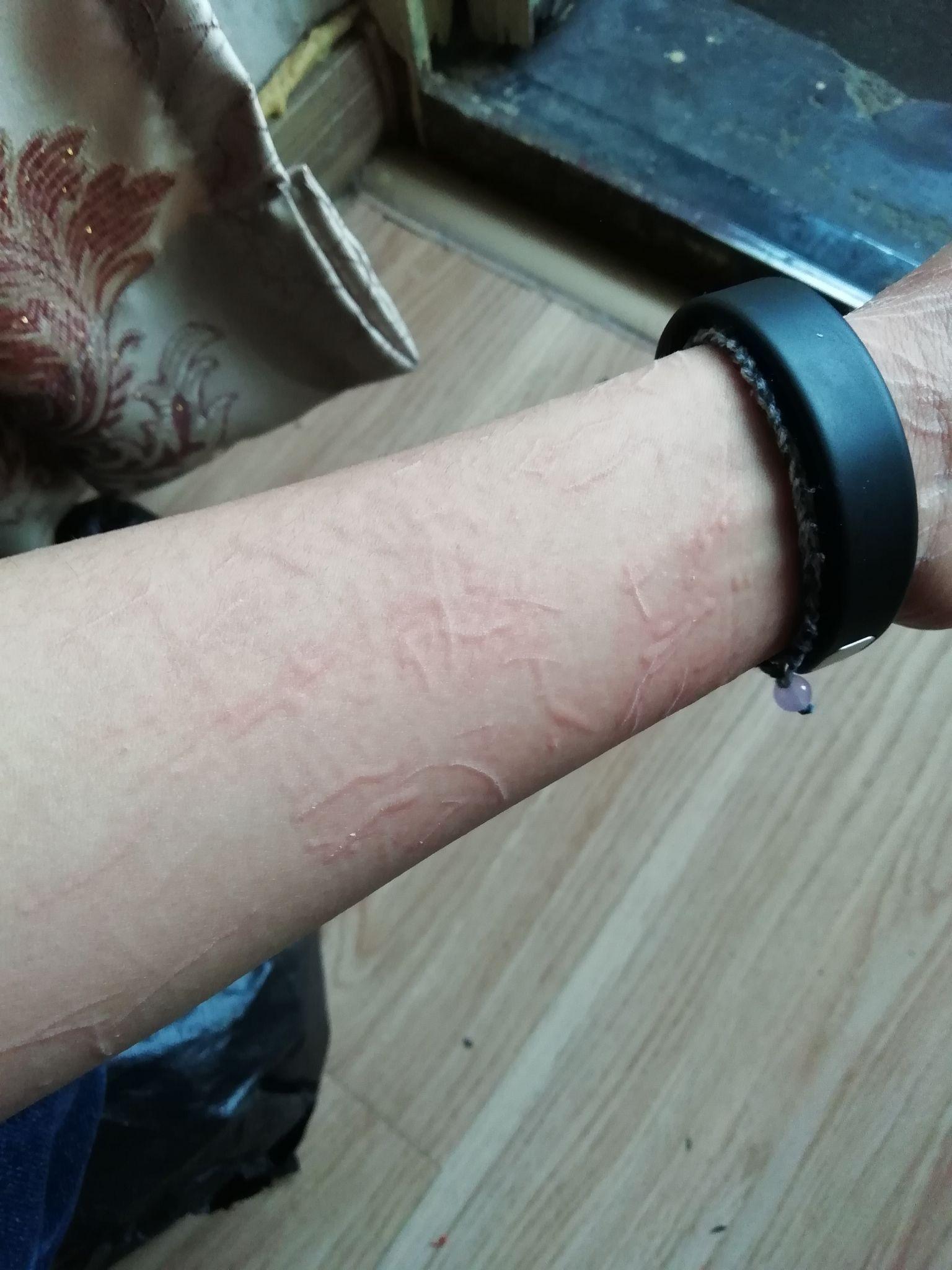 人工荨麻疹(皮肤划痕症)的原理是什么?有治疗的必要么?