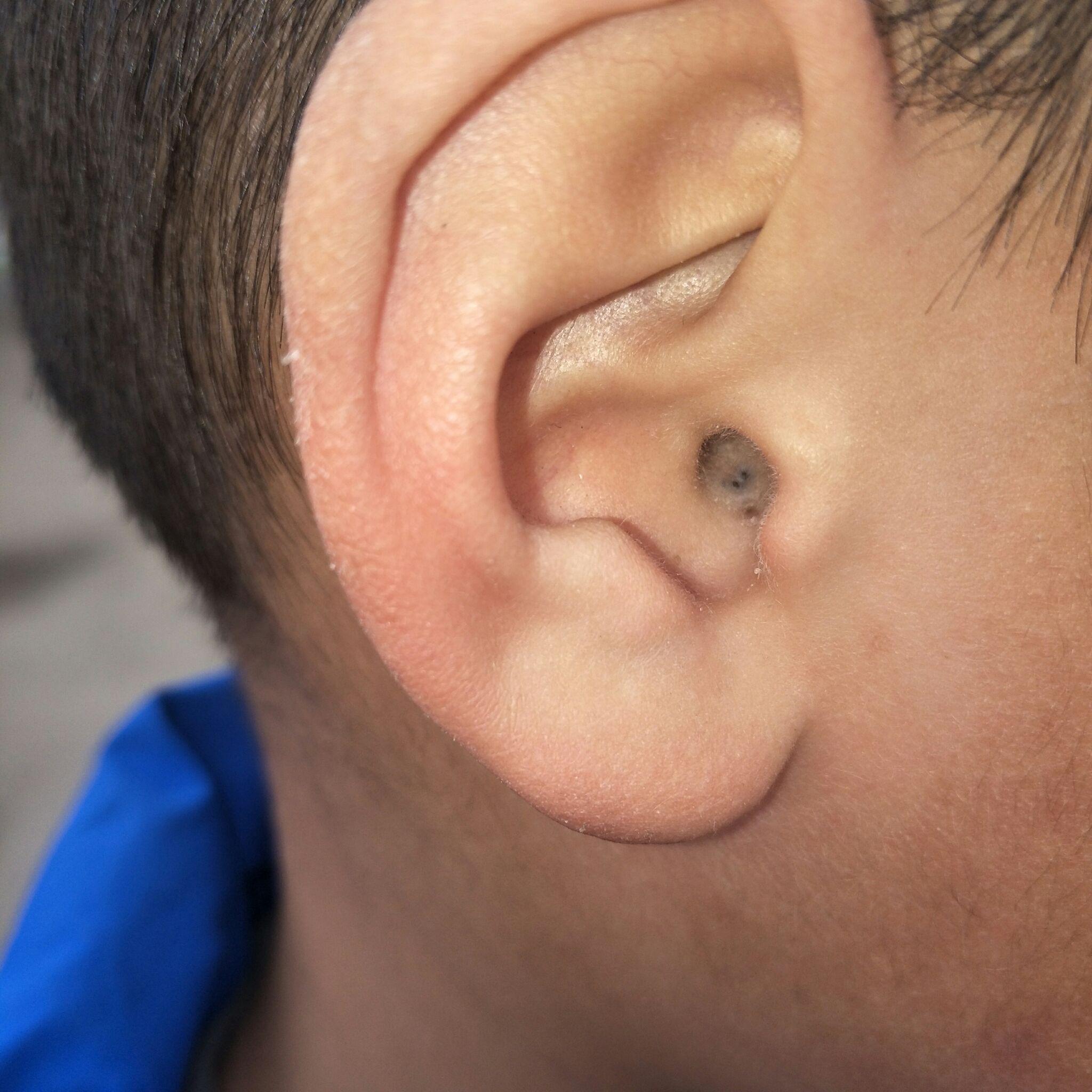 小孩子耳朵上有个小洞