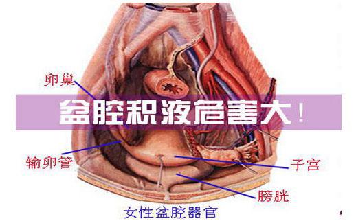 盆腔积液的位置图片图片
