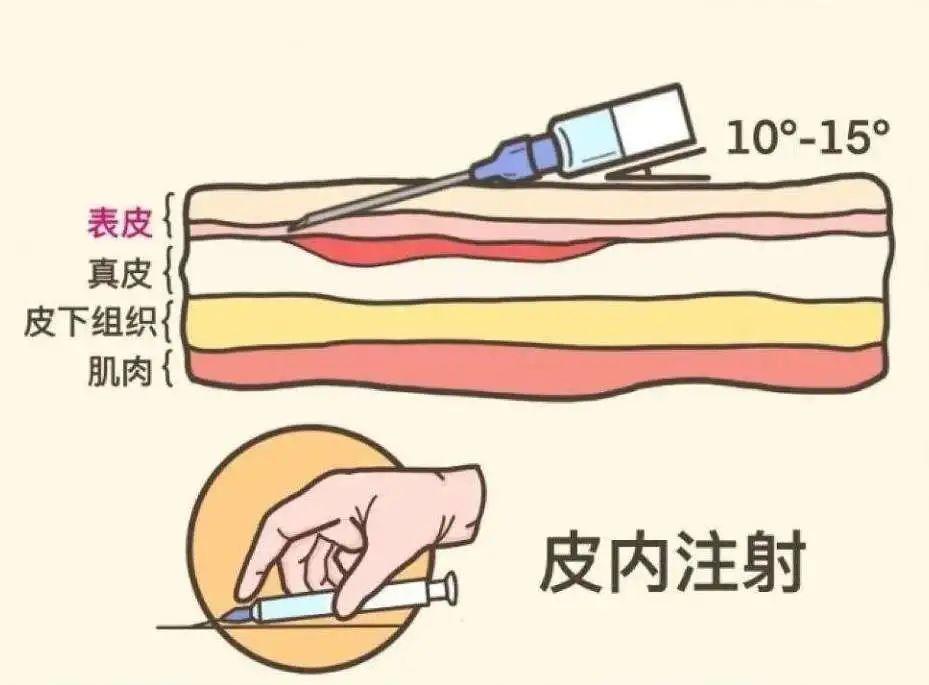 为了避免损伤坐骨神经,注射时的定位就要求非常精准