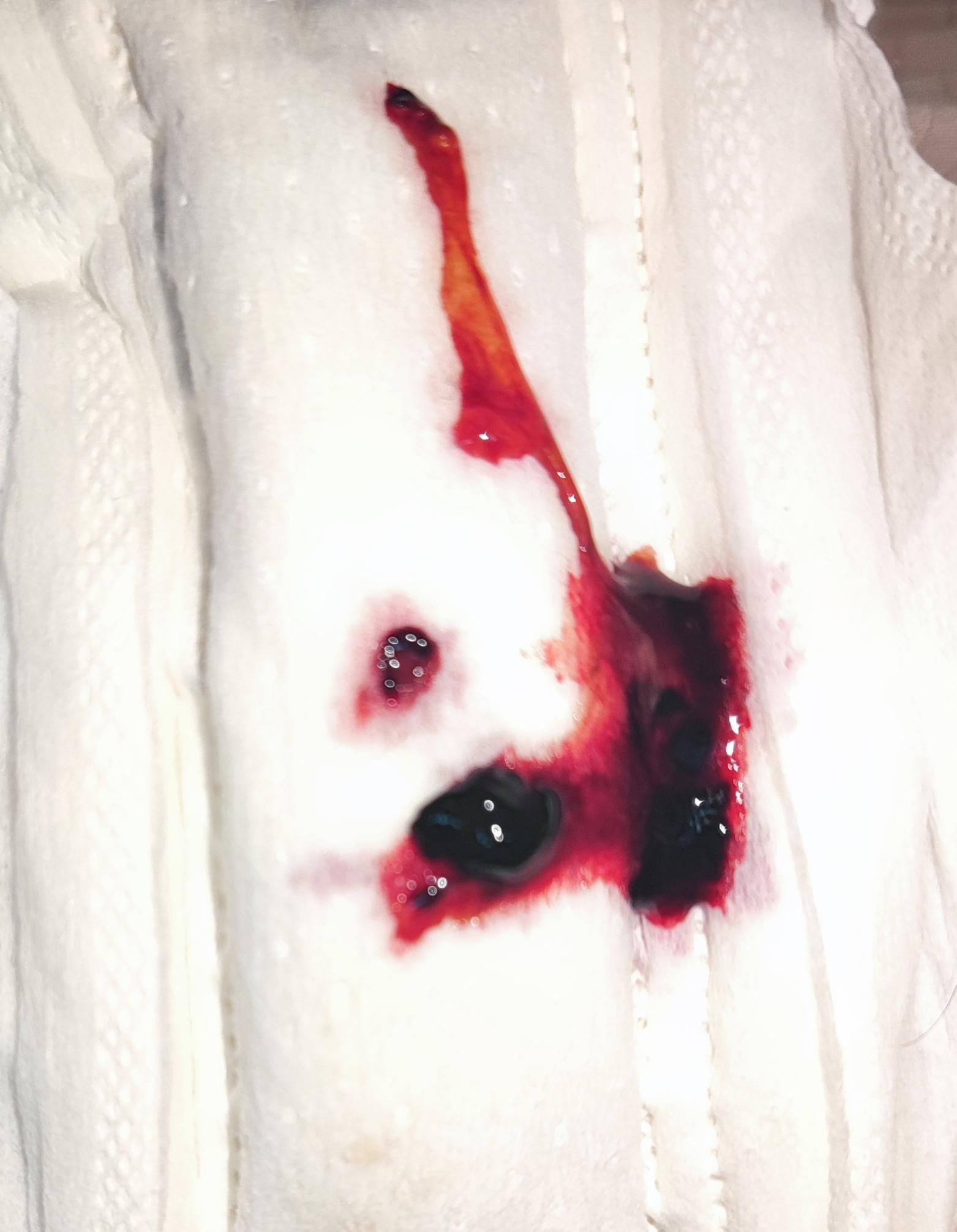 第五天排出了一坨血组织,开始流血,是为什么?