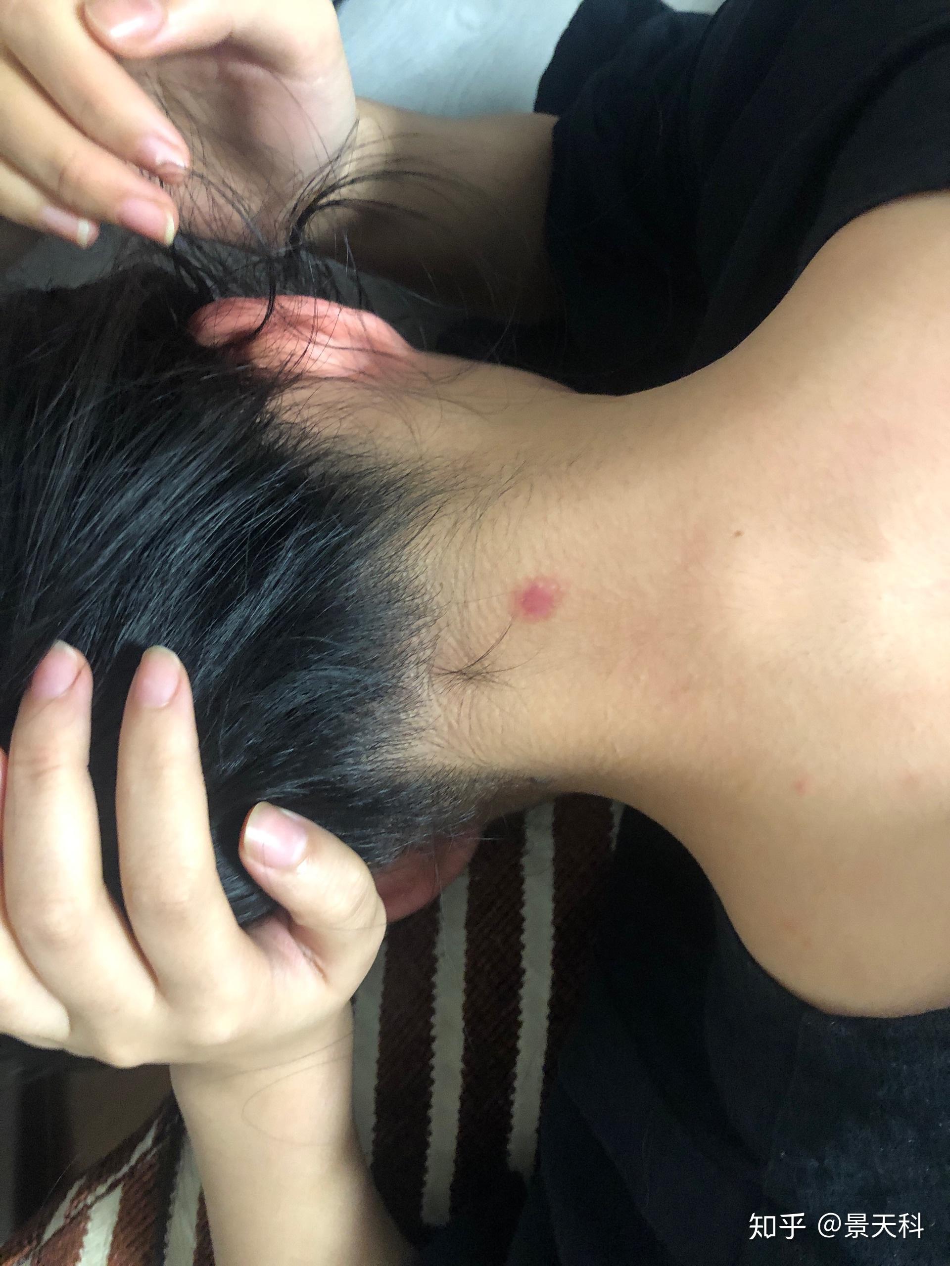 激光点痣记录脖子大痣