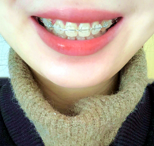 上海陶瓷半隐形矫正带牙套过程图