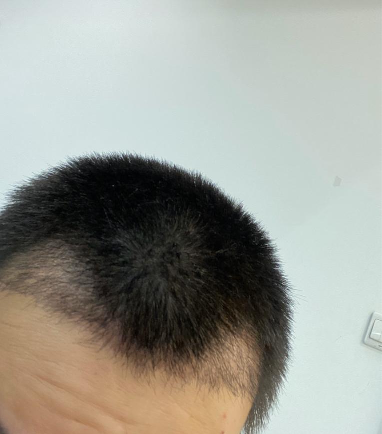 成都粉丝投稿m型秃顶发际线解决了2w2的植发记录大叔变小伙