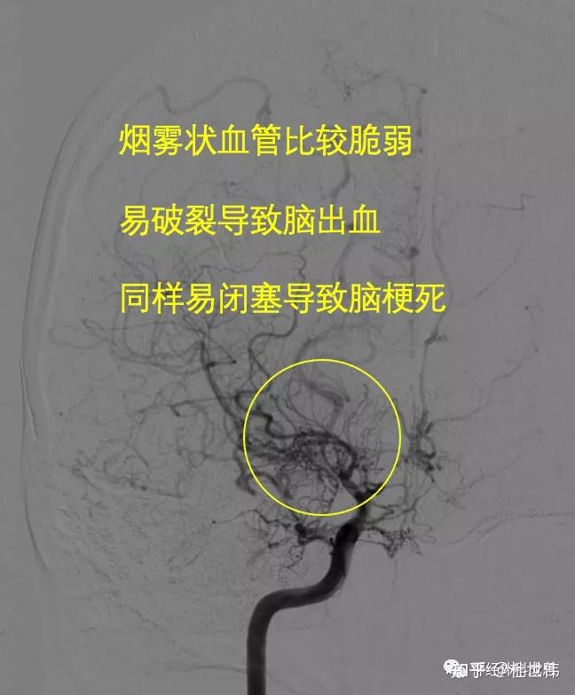 脑袋里冒烟的脑血管病烟雾病