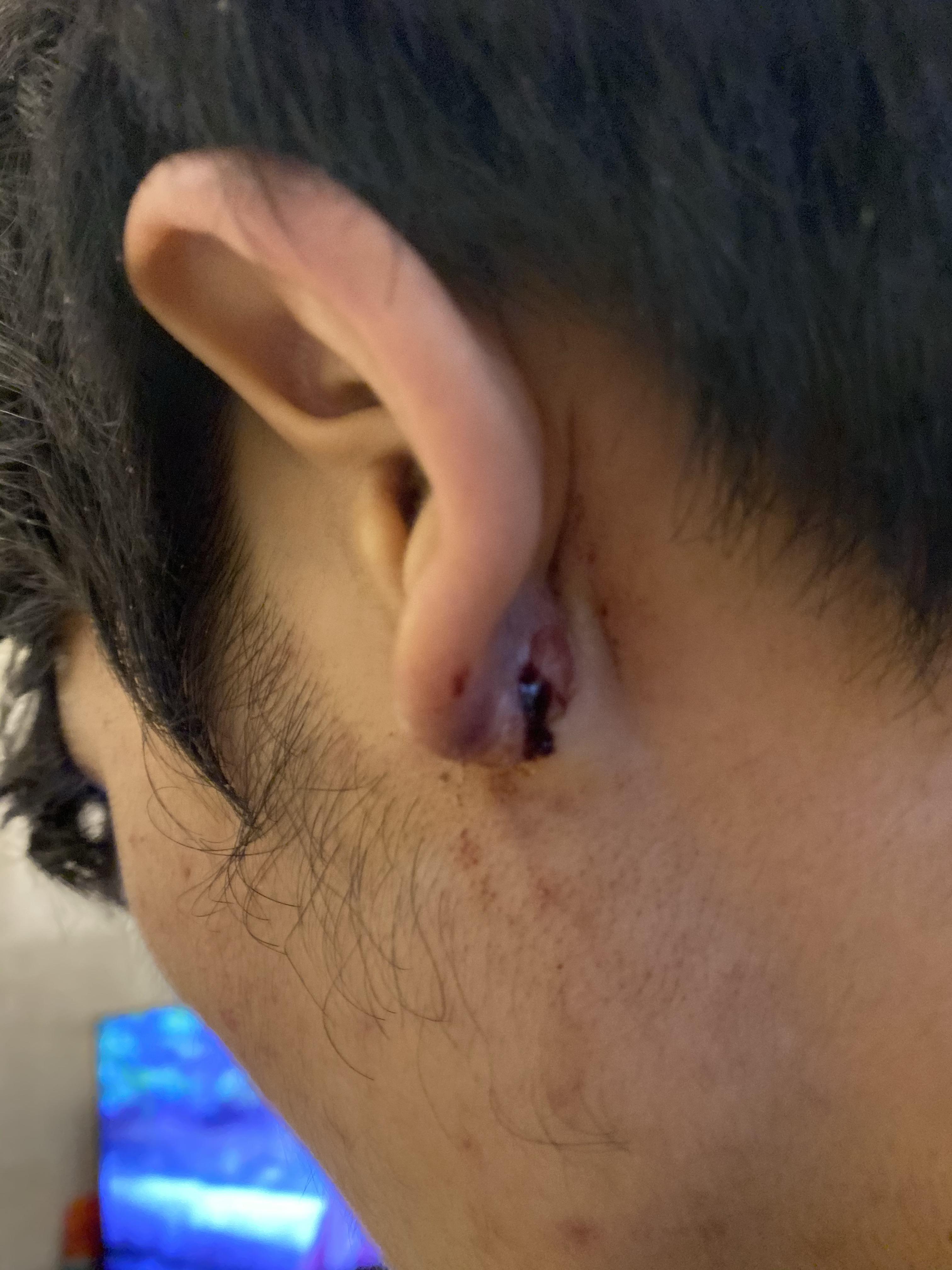 耳垂皮脂腺囊肿手术需要住院吗?