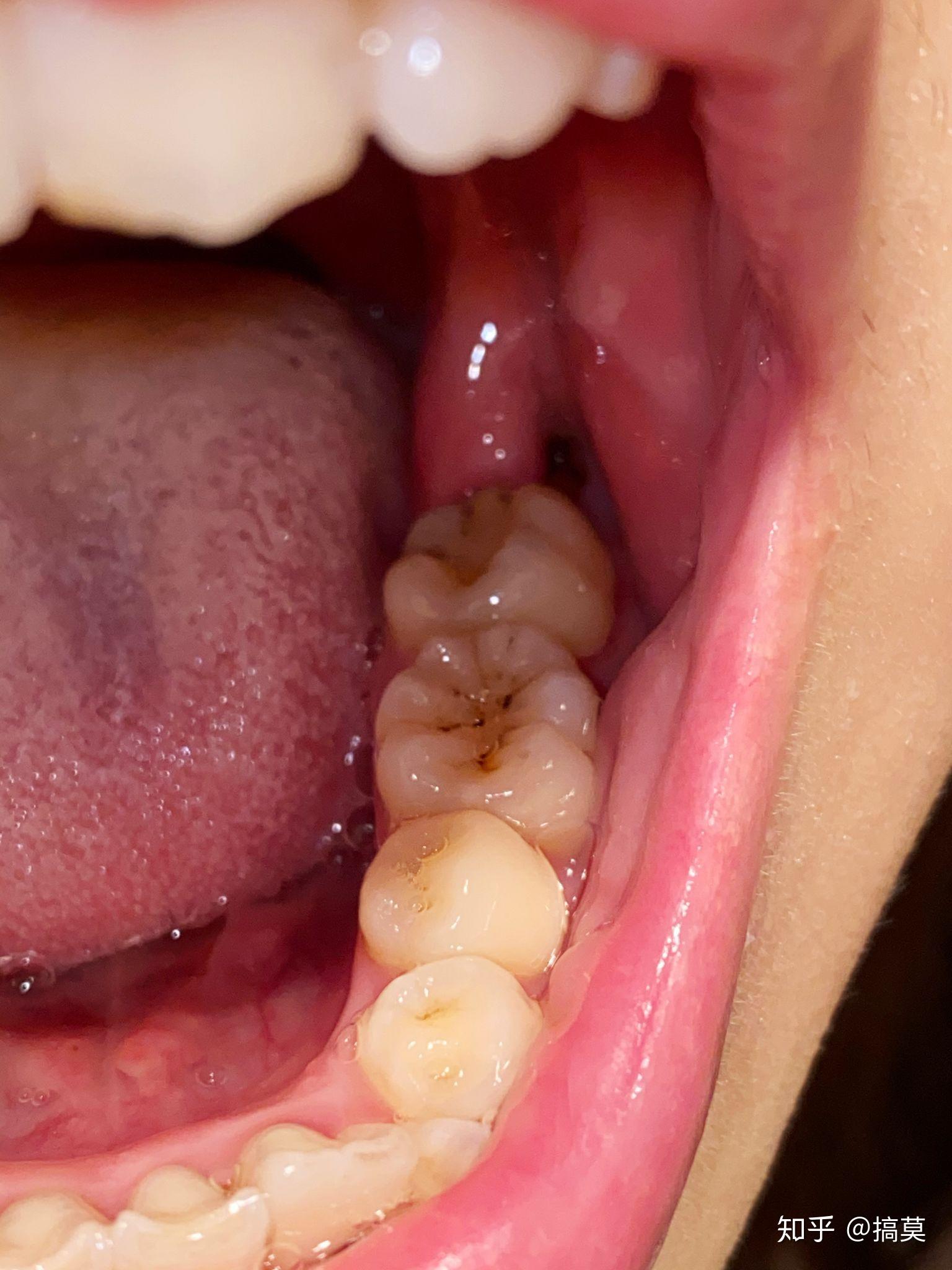拔完智齿以后口腔缝合拆完线怎么有个洞? - 知乎