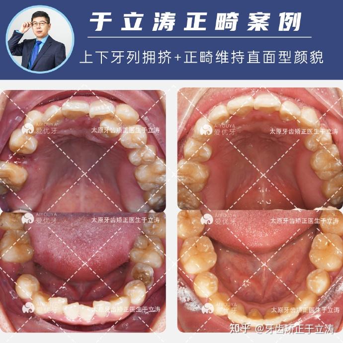 根據他的情況,我為他設計了右側拔除上頜第一雙尖牙,下頜第二已經齲壞