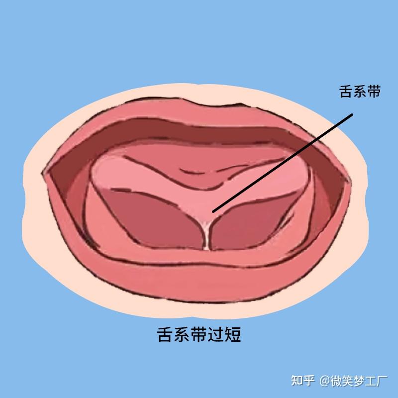 儿童口腔畸形，你真的了解吗？ - 知乎