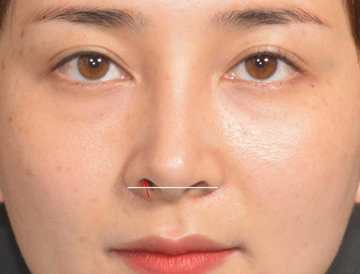 鼻中隔鼻综合+外切鼻翼 - 知乎