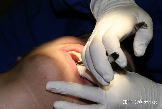 拔掉大牙会有什么影响? - 知乎