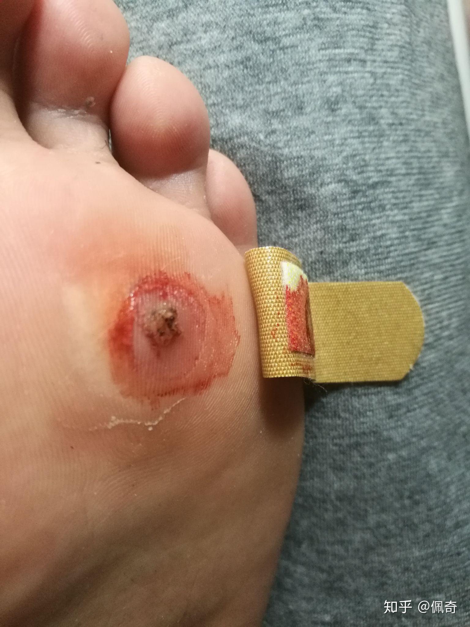 长了鸡眼要怎么治疗比较好呢