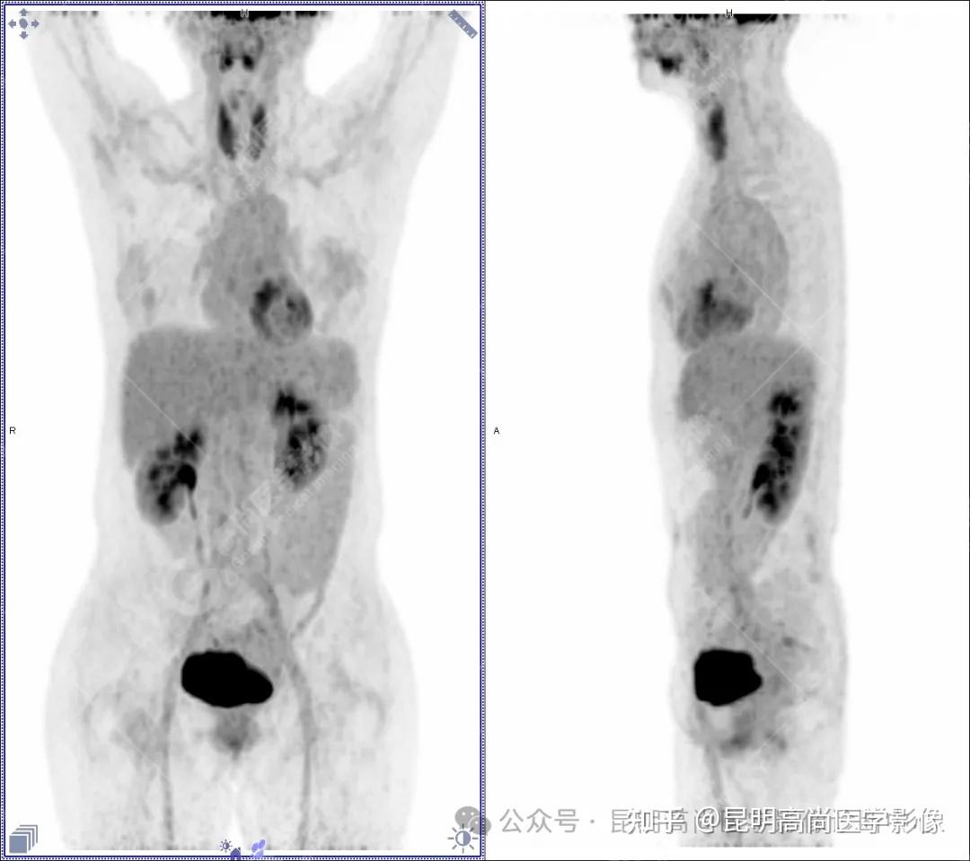 胰腺囊腺癌图片